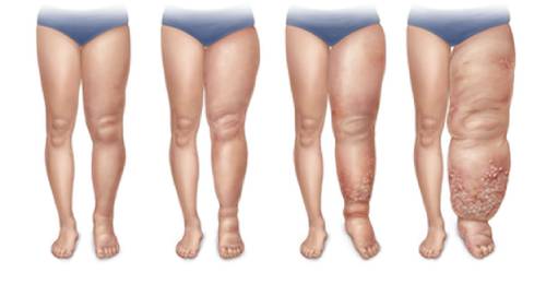 lymphedema-500